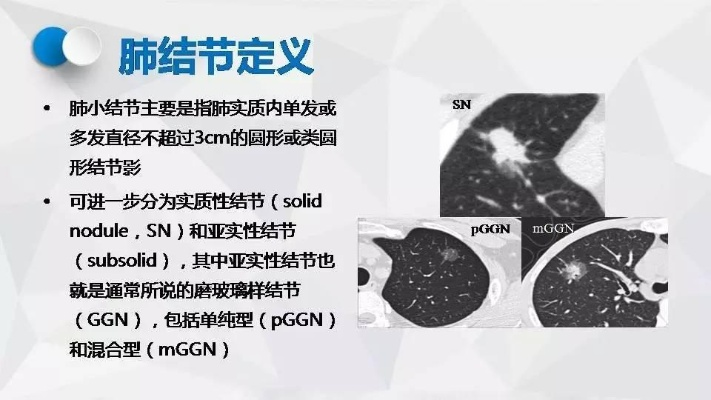 肺4cm结节的病情分析及治疗建议