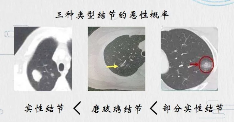 肺4cm结节的病情分析及治疗建议-第2张图片-www.211178.com_果博福布斯